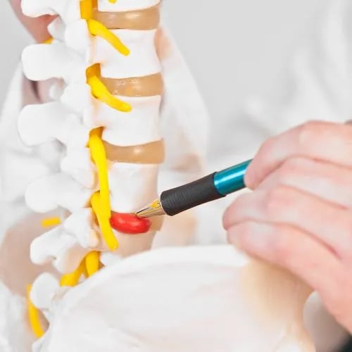 Paga de incapacidad por hernia discal