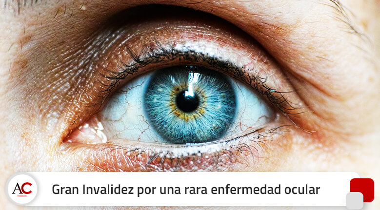 Gran Invalidez por una rara enfermedad ocular que solo afecta al 3% de la población